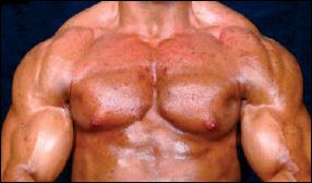 Extreme acne scars chemical bodybuilder (21) for life