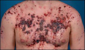 Extreme acne scars chemical bodybuilder (21) for life