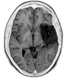 Walking and running can halve the chance of brain cancer