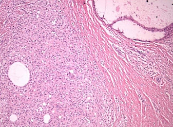 Needle swelling in bodybuilders misleads doctors