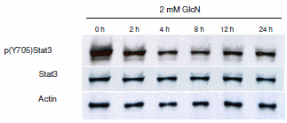 Glucosamine inhibits tough kinds of cancer