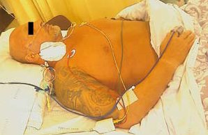 Blood clots in the heart destroy bodybuilder's liver