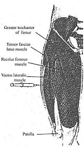 Needle swelling in bodybuilders misleads doctors