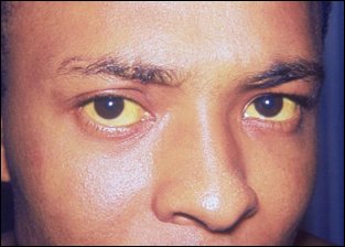 Bodybuilder gets jaundice from creatine and protein supplements