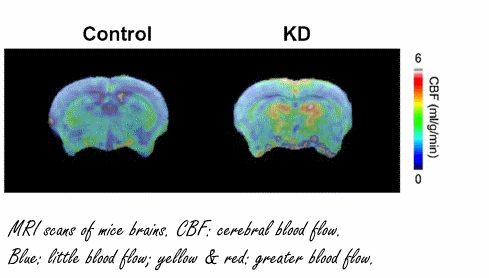 Ketogenic diet may help prevent dementia