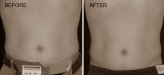 Laser treatment as an alternative to liposuction