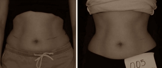 Laser treatment as an alternative to liposuction