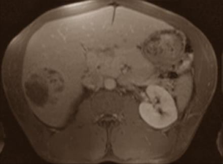 Liver cancer from anabolic steroids