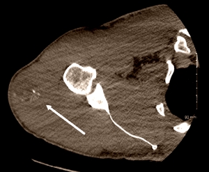 Myositis ossificans found in steroids user's delts