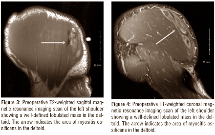Myositis ossificans found in steroids user's delts