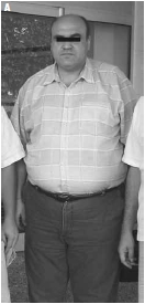 Nebido testosterone preparation restores fat man's health