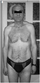 Nebido testosterone preparation restores fat man's health