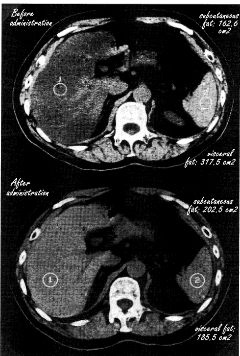 Pantethine treatment reduces visceral fat and fatty liver