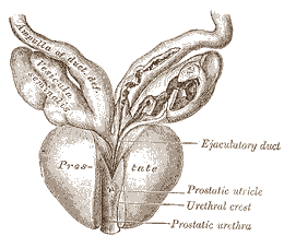 Testosterone supplement causes aggressive prostate cancer