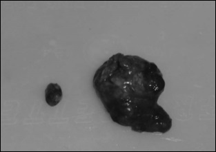 Eating lots of walnuts helps fight prostate cancer