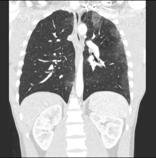 Coughing blood during steroids cycle