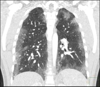 Coughing blood during steroids cycle