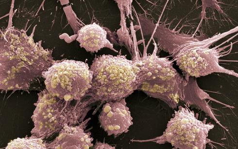 Prostate cancer cells die in the blood of active people