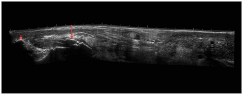 Bodybuilder injected coconut oil into his arms