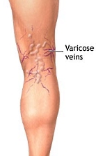 Raised estradiol level gives men varicose veins