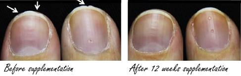 Hydrolysed collagen Verisol strengthens brittle nails